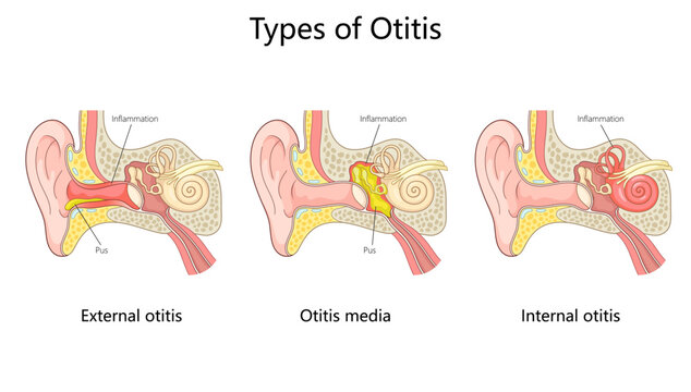 otitis ear infections external otitis, otitis media, and internal otitis with inflammation and pus buildup diagram hand drawn schematic vector illustration. Medical science educational illustration