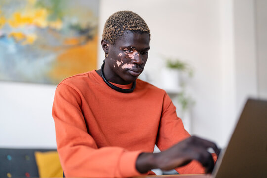 A young man with vitiligo dressed in an orange shirt types on a laptop while seated at a desk in a bright office with modern furniture and artwork, surrounded by a relaxed and professional atmosphere.