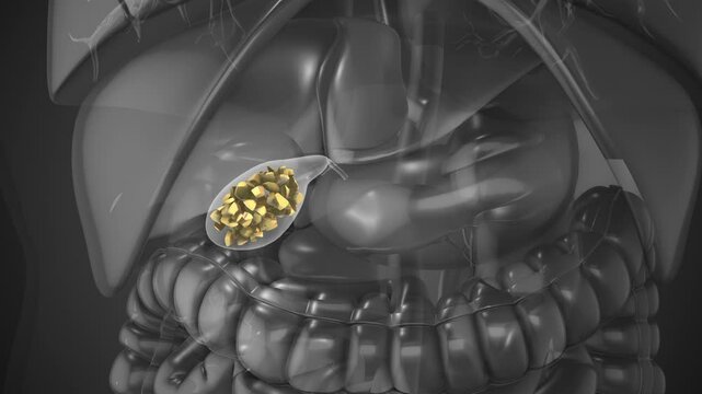 Gallstones Lodged in Gallbladder or Biliary Ducts