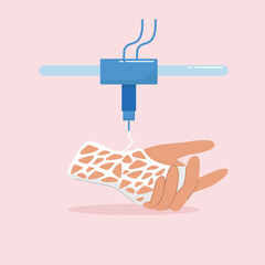 Hand plastic orthosis printed on 3D printer. Medicine and technology concept. Vector illustration in flat style.