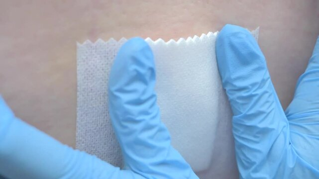 Close-up of surgical staples from a medical procedure, with blue-gloved hands applying a dressing, symbolizing surgery, healing, and healthcare