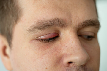 Selective focus on swollen and painful red upper eye lid with onset of stye infection due to...
