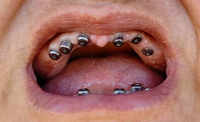 Obraz premium Dental implants, all in six, dental ceramic restoration, 37.