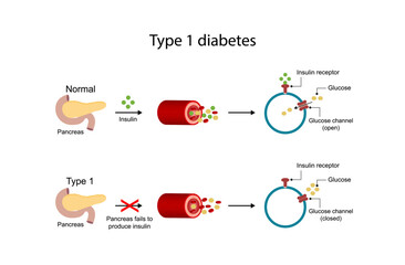 Diabetes mellitus type 1, pancreas's failure to produce enough insulin and type 2, cells fail to respond to insulin (Insulin resistance). Result in high blood glucose levels. Vector illustra