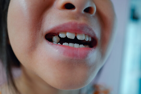 Real life of Asian girl has a tooth falling out