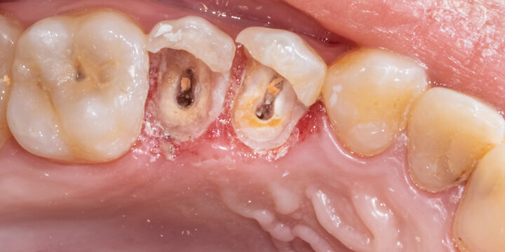 Premolars crowns destroyed with visible root canals and dental caries in the central incisor. Upper maxillary arch closeup view with decayed teeth. Gingival gum bleeding in post surgery cicatrisation.