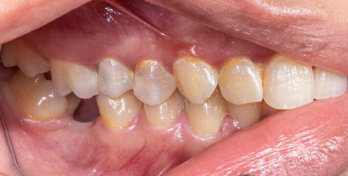 Lateral view of dental arches in biting occlusion with a lost lower molar tooth missing crown. Yellow colored spots teeth closeup macrophotography indirect mirror view open mouth retracted lips.