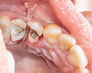 Resin composite restoration with post and core build up. Premolars teeth, separated with a metallic strip and interdental wedge, crown reconstruction with metallic posts sealed in the root canals.