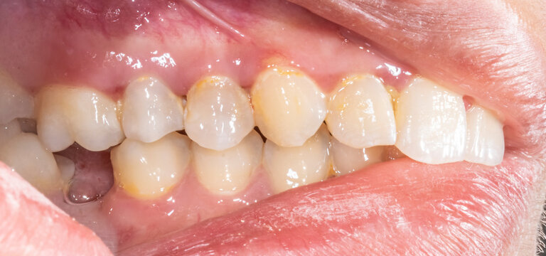 Lateral view of dental arches in biting occlusion with a lost lower molar tooth missing crown. Yellow colored spots teeth closeup macrophotography indirect mirror view open mouth retracted lips.