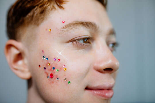 a man with acne and pimples with rhinestones