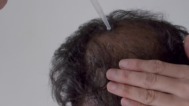 An Indian man with a dropper applying essential hair oil on his bald patches for androgenic alopecia, hair loss treatment.