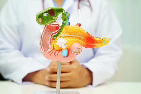 Pancreatitis, pancreatic cancer, Asian doctor with pancreas, gallbladder and bile duct human anatomy model at hospital.