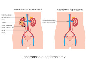 Kidney removal or nephrectomy is surgery to remove.