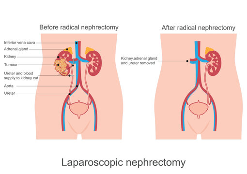 Kidney removal or nephrectomy is surgery to remove.
