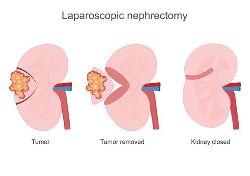 Nephrectomy is a major procedure performed.