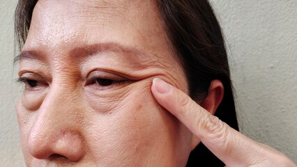 portrait the fingers holding the flabbiness and wrinkle beside the eyelid, swelling and ptosis under the eye, scar and freckles on the face of the woman, health care and beauty concept.
