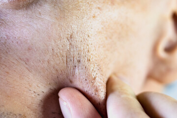 Fototapeta premium Enlarged pores on oily skin. Scars after acne on face skin. Problem skin treatment. Close up.