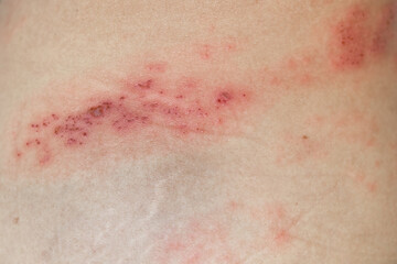 Closeup of Herpes Zoster shingles on a woman back skin