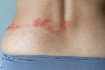 Closeup of Herpes Zoster shingles on a woman back skin