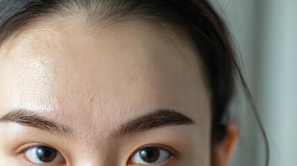 Forehead with mild pigmentation disorder, soft background,