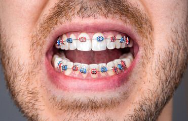 Closeup of a man's teeth with braces. Male smile in braces, white teeth. Closeup of man mouth with...