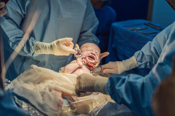 The umbilical cord is visible around the neck of a newborn undergoing cesarean section. This medical moment highlights the intricacies and care involved in childbirth, focusing on the delicate process