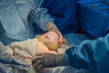 A baby is delivered in an intact amniotic sac during a caesarean section. The medical team carefully performs the procedure, highlighting the precision and care involved in this unique birth scenario