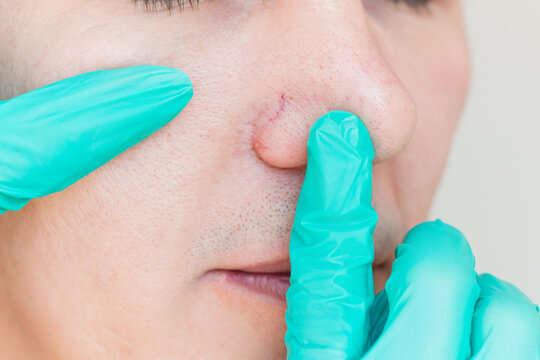Close up doctor in green gloves examining the inflamed blood vessels on the nose of a young man suffering from couperose. Dermatological problems.