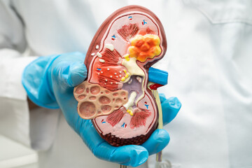 Kidney disease, Chronic kidney disease ckd, Doctor hold human model to treat and study in hospital.