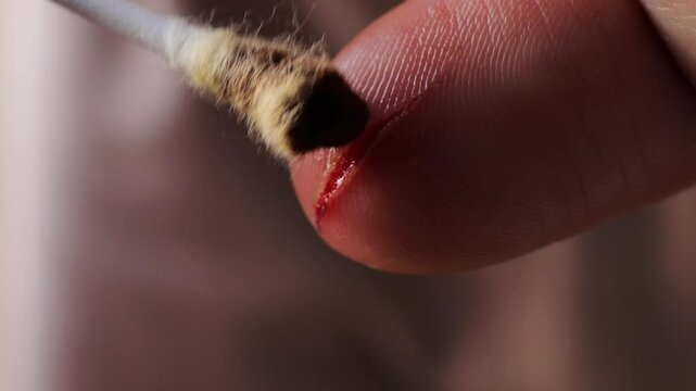 Bleeding finger from a knife cut. deep wound on thumb. First aid measures are essential to prevent infection and treat injury. Proper bandaging and antibacterial treatment ensure safety