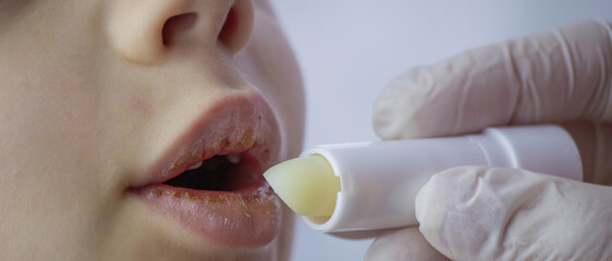 boy with chapped lips treatment. Selective focus