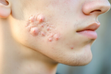 Close-up of severe acne on a teenager's face, with inflamed pimples, blackheads, and cysts
