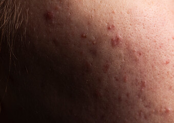 Dermatological acne. Skin texture background. Closeup acne pimple. Problem skincare. Pimples, acne,...