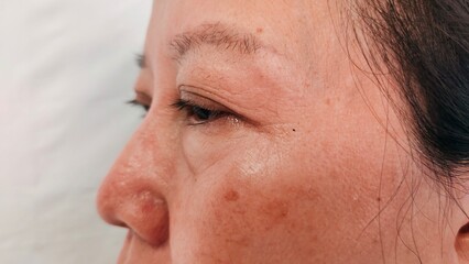 portrait freckles and blemish on the cheek, swelling and ptosis beside the eyelid, dullness and scar on the face of the woman, health care and beauty concept.