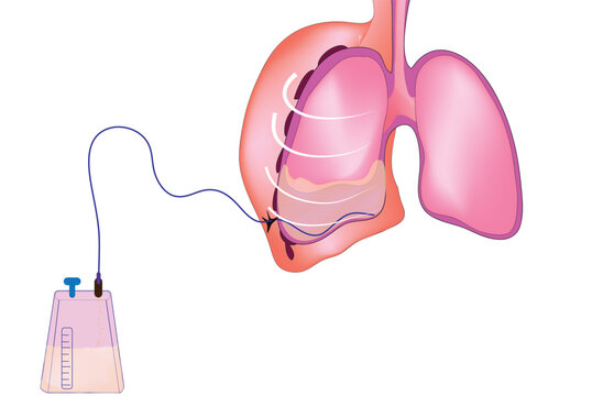 Pleural effusion (Accumulation of excessive fluid in the pleural space, the potential space that surrounds each lung.)