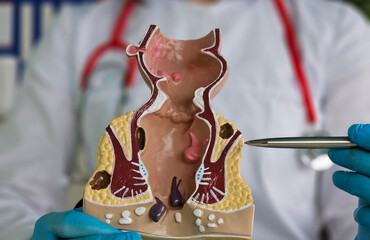 Doctor holds pen and rectum model with inflammation