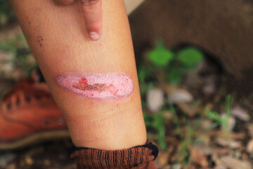 dry open wound on kid leg from accident in daily life. health care living life about kid concept.