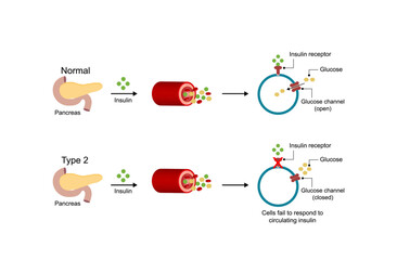  Diabetes mellitus type 2, cells fail to respond to insulin (Insulin resistance). high blood glucose levels. Scientific diagram illustration.