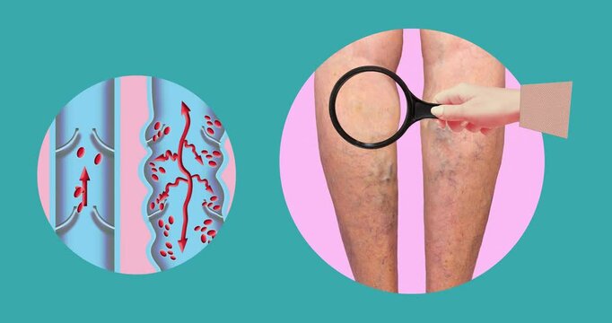 Varicose veins on a female senior legs. The structure of normal and varicose veins. Concept of dry skin, old senior people, varicose veins and deep vein thrombosis or DVT - 2D animation