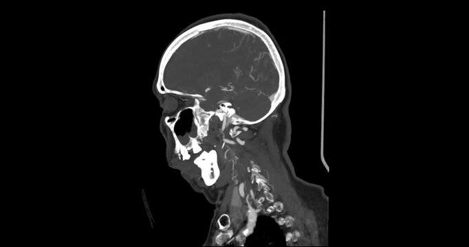 Dynamic CTA brain scan showcasing detailed vascular structures, highlighting blood flow and arterial formations for medical diagnostics and research.