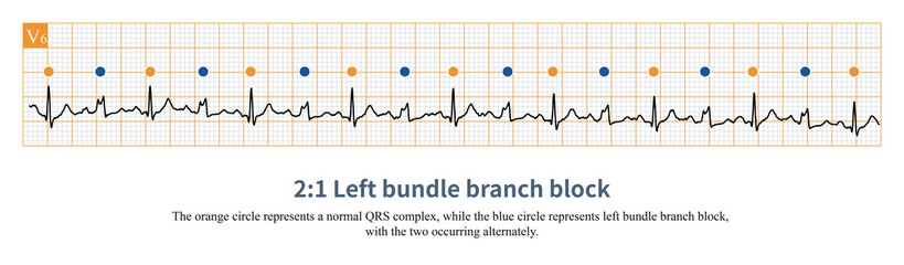 When a  2:1 bundle branch block occurs, the refractory period of the bundle branch is longer than one basal cardiac cycle but shorter than two basal cardiac cycles.