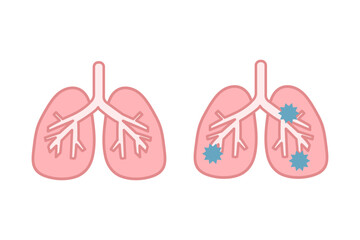 健康な肺と病気の肺のイラストセット
