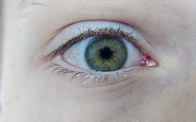 Obraz premium Irritated red blood eye full with capillar net. Conjunctivitis after flu, cold or allergy