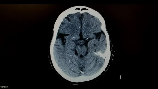 Brain CT with Cysticercosis, hydrocephalus and shunt in place
