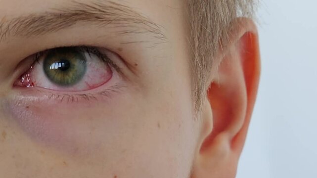 Irritated red blood eye full with capillar net