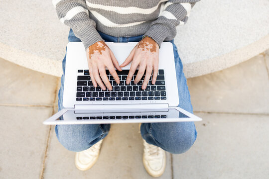 Mixed Race Person with Vitiligo Using Laptop at University