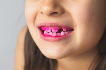 Close up of 7 year old girl's teeth with pink plaque indicator solution applied to teeth, concept...