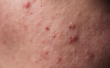 Dermatological acne. Skin texture background. Closeup acne pimple. Problem skincare. Pimples, acne,...