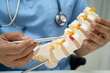 Asian doctor holding spinal nerve and bone model, Lumbar spine displaced herniated disc fragment...