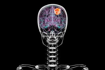 Brain tumor, 3D illustration